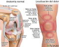 Dolor de rodilla