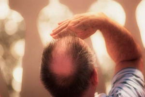 Alopecia andrognica en el hombre