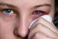 Clamidia ocular (sntomas, tratamiento)