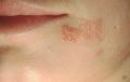 Herpes simple, una infeccin sin cura definitiva (tratamientos)