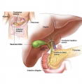 Litiasis Vesicular: Clculos o piedras en la vescula
