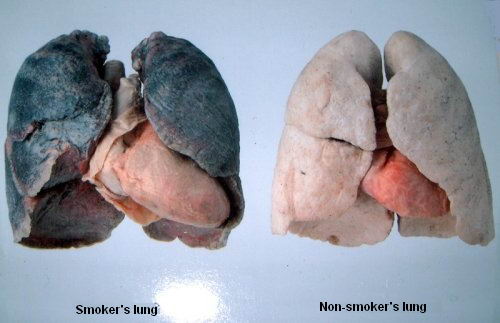 Pulmones de un fumador, y pulmones de un no fumado Pulmones de un fumador, y pulmones de un no fumado