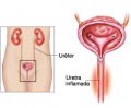Uretritis no gonoccica (Clamidia)