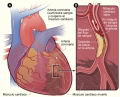 Infarto Agudo de Miocardio (Ataque Cardaco) [C. Cardiovasculares]