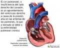 Cor pulmonale (enfermedad cardaca pulmonar) [C. Cardiovasculares]