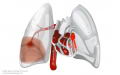 Tromboembolismo Pulmonar (Obstruccin Arterial Pulmonar) [C. Cardiovas.]