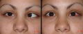 Estrabismo: Desviacin o desalineacin de los ojos