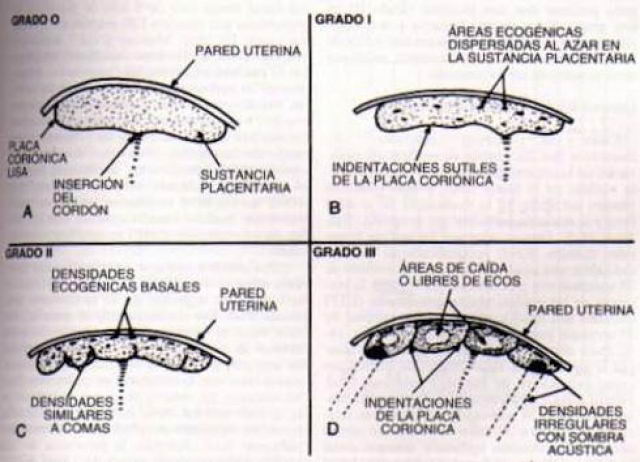 Madurez de la placenta segn la clasificacin de Grannum.
