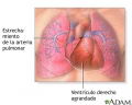 Hipertensin Pulmonar [C. Cardiovasculares]