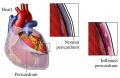 Pericarditis (Inflamacin del pericardio) [C. cardiovasculares]