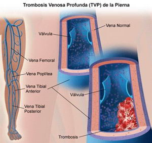Trombosis venosa profunda