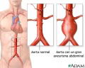 Aneurisma (dilatacin de los vasos sanguneos) [C. cardiovasculares]
