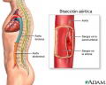 Diseccin artica (aneurisma artico disecante) [C. cardiovasculares]