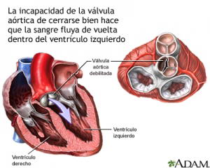  Insuficiencia artica