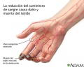 Tromboangetis obliterante (enfermedad de Buerger) [C. cardiovasculares]
