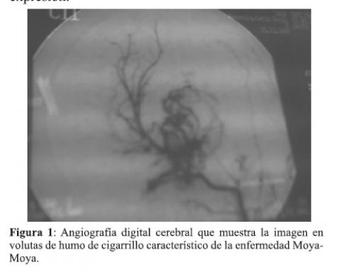 Sndrome de Moyamoya/Imagen: Web