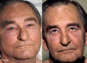 Sndrome de la Vena Cava Superior en una persona con carcinoma broncognico. Ntese la hinchazn de la cara a primera hora de la maana (izquierda) y su resolucin despus de permanecer en posicin vertical durante todo el da (a la derecha).