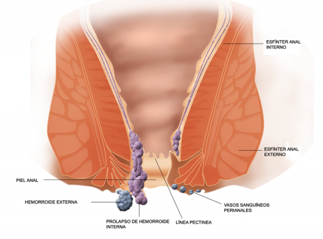 Hemorroides.