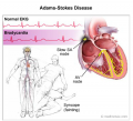 Sndrome de Stokes-Adams [C. cardiovasculares]