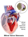 Estenosis mitral (estenosis del vlvula mitral) [C. cardiovasculares]