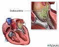 Endocarditis: Inflamacin del endocardio [C. cardiovasculares]