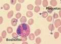 Fibrosis endomiocrdica (enfermedad de Davies) [C. cardiovasculares]