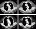 Aortitis (inflamacin de la arteria aorta) [Condiciones cardiovasculares]