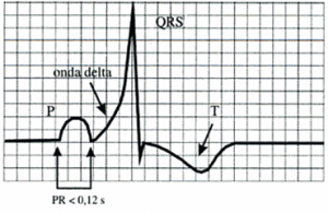 Sndrome de WPW: Alteraciones en el ECG basal./Fig.2 del libro Electrocardiografa en la prctica clnica Editado por: Francisco Javier Chorro Gasc.
