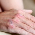 Conozca las causas de la psoriasis y cmo tratar esta enfermedad