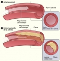 Ateroesclerosis (endurecimiento de las arterias) [C. cardiovasc.]