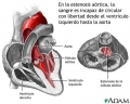 Estenosis artica [C. cardiovasculares]