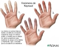 Fenmeno de Raynaud (espasmos vasculares) [C. cardiovasculares]