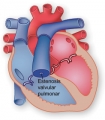Estenosis valvular pulmonar [C. cardiovasculares]