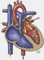 Insuficiencia mitral o regurgitacin mitral [C. cardiovasculares]