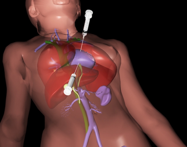 Pericardiocentesis (insercin de una jeringa en la cavidad pericrdial para absorber el lquido)
