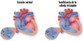 Insuficiencia tricuspdea [C. cardiovasculares]