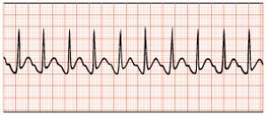 Electrocardiograma de un paciente con taquicardia paroxstica.