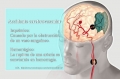 Derrame cerebral: Accidente cerebrovascular (ACV)