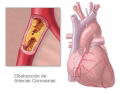 Crestor (rosuvastatina), como terapia Cardiovascular