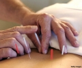 Beneficios de la Acupuntura (Medicina Tradicional China)