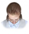 Alopecia Femenina (cada del cabello, calvicie en la mujer)