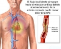 Angina de pecho (dolor de pecho) [C. Cardiovasculares]