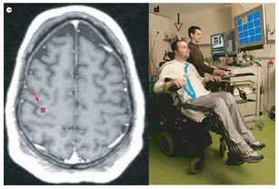 neuroprosthetic, assistive device, neuroprostheses, neuroprosthesis, brain implant, motor impairment, SCI, spinal cord injury, ALS, amyotrophic, sclerosis, stroke, espina dorsal, distrofia muscular, apoplejía, enfermedad neuromotriz, braingate, implante cerebral, paralitico, paraplejico, tetraplejico, cerebro, chip de silicio