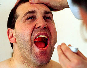 La Candidiasis oral produce manchas blancas o rojas en la lengua La Candidiasis oral produce manchas blancas o rojas en la lengua