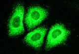 tratamiento para la hepatitis, causas de la hepatitis, el virus de la Hepatitis C, que es la hepatitis C, insuficiencia heptica debida a la hepatitis C, insuficiencia heptica, cancer del higado, hepatitis C