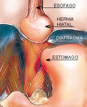 La hernia en el hiato impide que la comida se quede en el estómago. (Foto: Estampas/El Universal) La hernia en el hiato impide que la comida se quede en el estómago. (Foto: Estampas/El Universal)