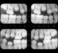 Radiografa dental interproximal, una imagen interna de las caries
