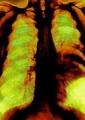 Riesgo de mesotelioma y cncer del pulmn por Asbestos