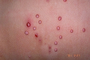 Las verrugas suelen aparecer en el cuello, axilas, cara, manos, abdomen y en los genitales Las verrugas suelen aparecer en el cuello, axilas, cara, manos, abdomen y en los genitales