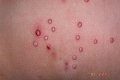 Molusco Contagioso, una ETS visible